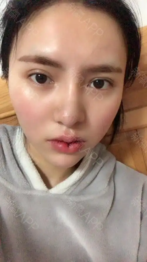 南京m唇手术好不好_效果图_尤如梦霓裳m唇手术术后第5天_新氧美容整形