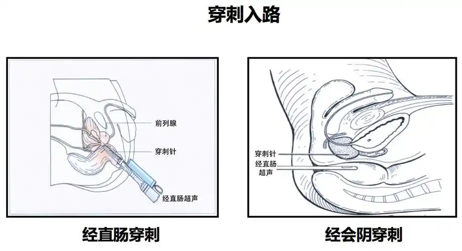 前列腺穿刺入路.jpg