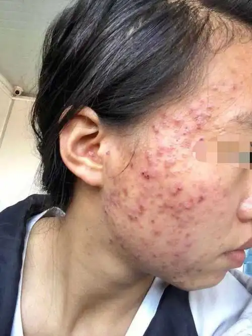 我绝对是个祛痘典范!港真的!