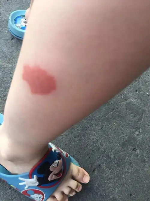 儿子放学回来小腿上红的一大块一大块,红,不痒,按下痛