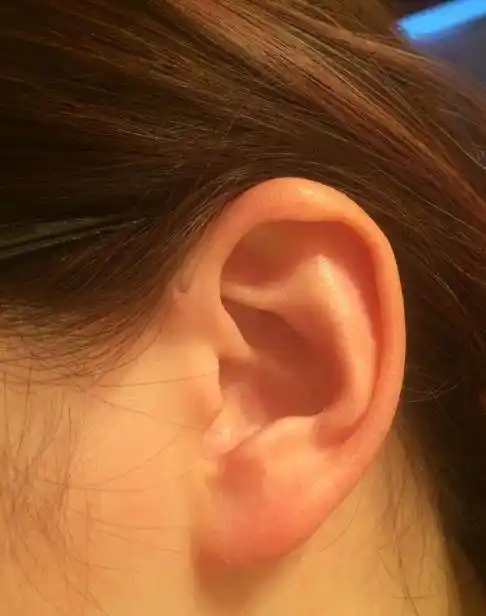 宝宝耳朵有"聪明孔",好奇宝妈挤了一下,差点要了孩子的命_手机搜狐网