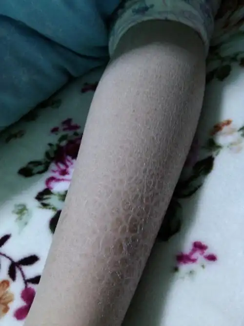 小孩子皮肤全身都是粗糙的鱼鳞状是什么病?该怎么治疗