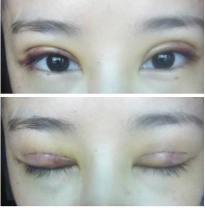 双眼皮术后七天拆线,恢复的还不错