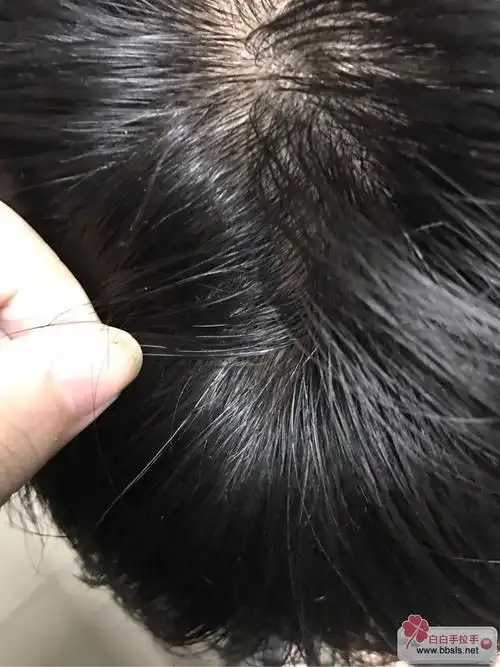 求助四五根白头发长在一块可能是白白吗?