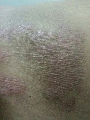 体癣初期图片 (31)