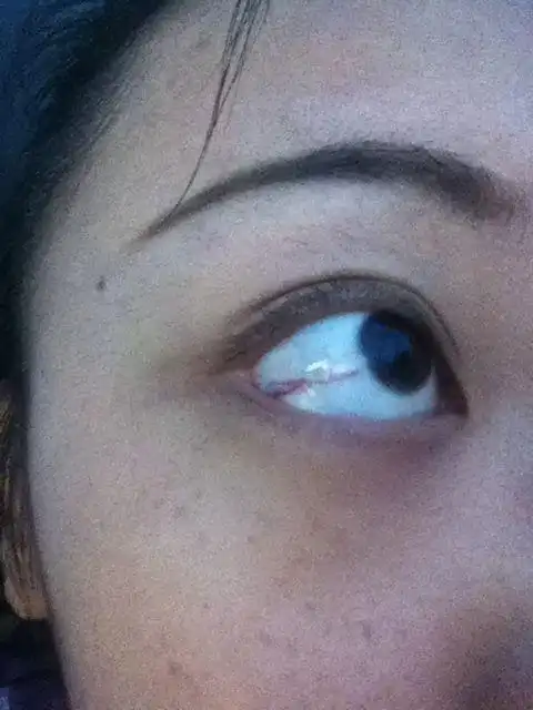 我生下来眼睛里就有两条血丝,一条红色的细细的,另外一条是紫色的血管