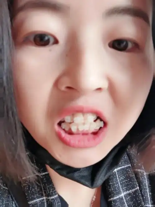 啥也憋说牙齿变形图片牙齿变形牙齿变形严重图片牙变形照片牙变形变形