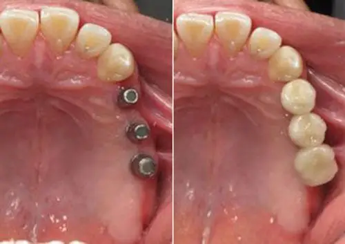 在深圳做过种植牙后的亲身经历,告诉你哪家医院种牙好?