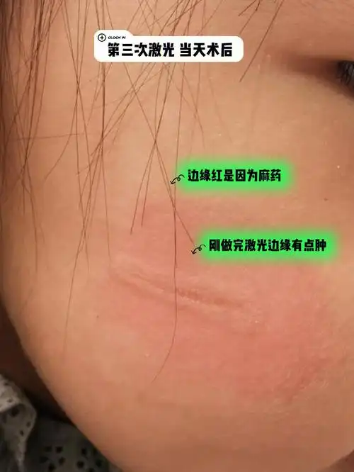 更新(9)‖凹陷伤疤第三次激光7天