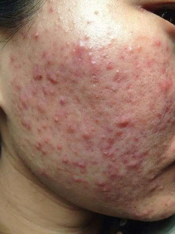 女生脸上出油长痘痘原来都是这个因素在作怪三个方法搞定