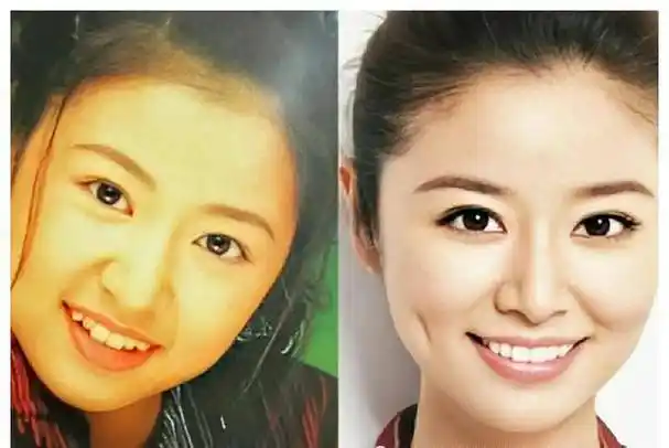 像林心如这样的牙齿,确实是整了比不整好看.