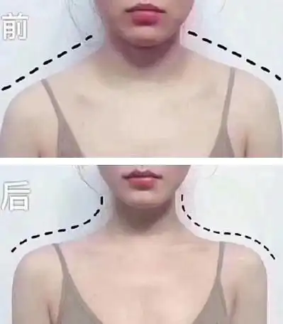 该方法对于脖子较短,露肩没自信,看不见锁骨,斜方肌发达的人都很友好