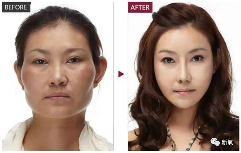 高圆圆一夜变美是颧骨内推还是自然衰老的关键分析