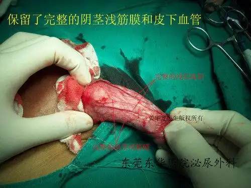 小儿包皮环切术后3周 "包皮环切"小手术,对每个要手术的男士来说,都是