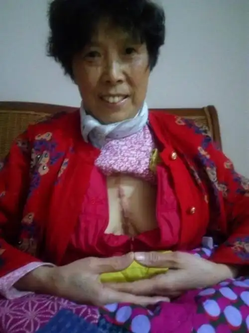 【转载】汤晓琪同修分享修练大道远离曾经心脏开胸手术苦不堪言的生活