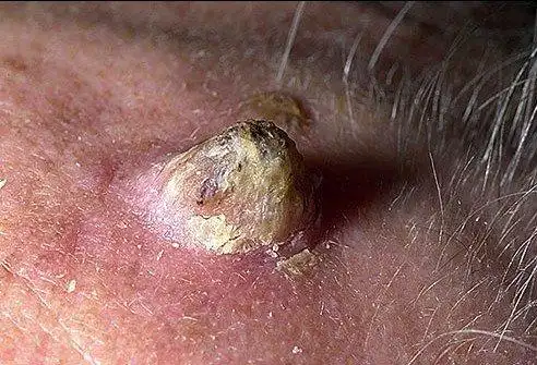 看图识病各种皮肤癌及癌前病变的不同表现