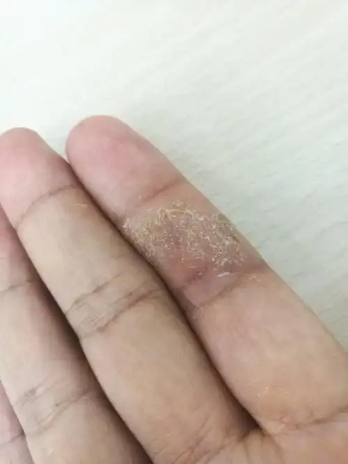 手指上长了这种癣,很庠,掉皮,撕破了又痛,半年了.是什么?怎么治?