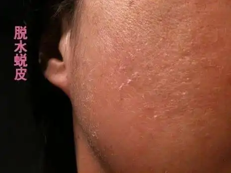 兰蓉锦囊变薄的角质层如何养厚呢