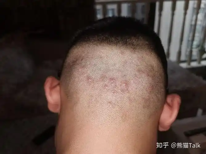头皮上长痘痘是什么样的感觉? - 知乎