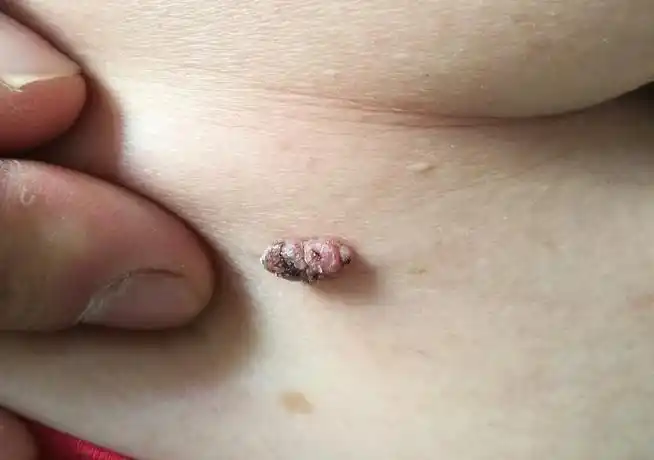 两味药,久服,可消融腹中一切积聚    现在好多人身上都会长一种肉疙瘩