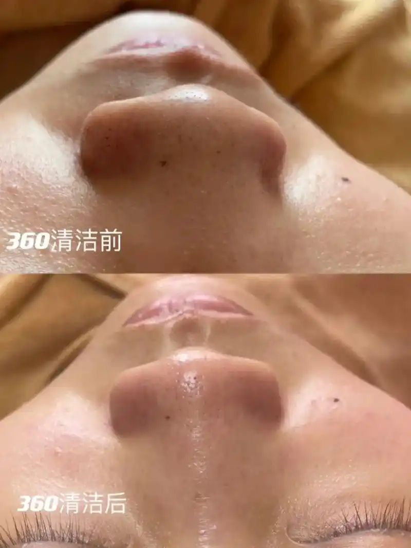 不做清洁的保养 #都是在花钱养死皮 韩国小气泡深层清洁皮肤 - 抖音