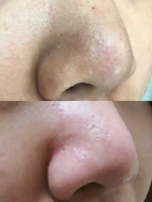 鸡蛋清真的可以去黑头吗