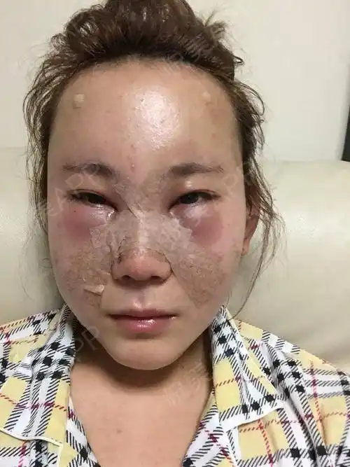 自体脂肪面部填充第4页_面部填充第4页_自体脂肪第4页_面部轮廓第4页