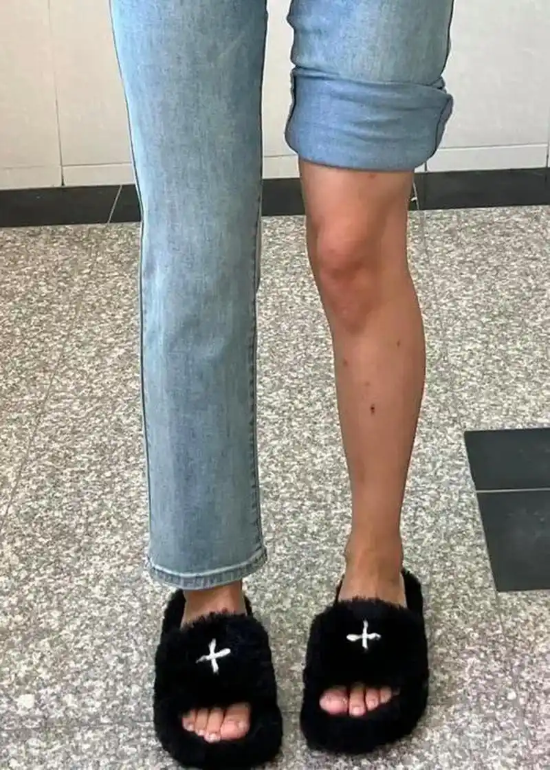 如果你的腿弯曲度超过正常范围,可以尝试以下方法来矫正腿弯:  烬正