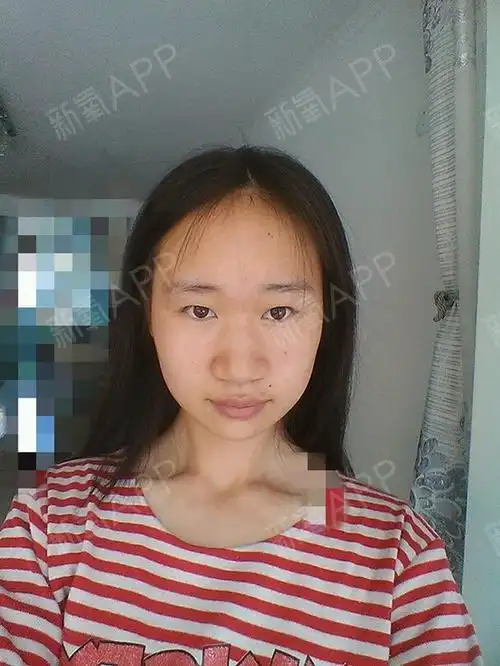 鼻子我鼻翼下塌鼻骨宽没山根鼻翼肥大微整形可以使鼻子改善么