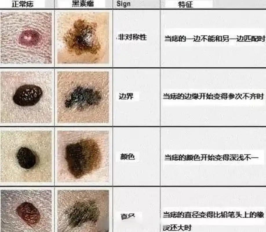 什么样的痣可能是黑色素瘤?