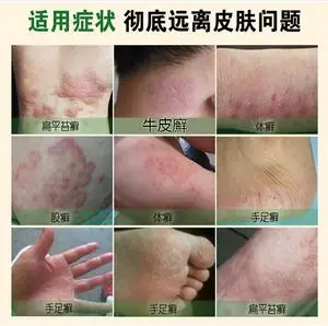 牛皮藓鲜银屑病专治疗头皮手足脚体股藓廯湿疹皮肤外用特效癣药膏
