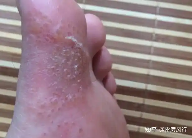 水泡型脚气的水泡需要戳破吗还是用药后会自动消掉呢