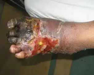 血管重建结合清创后负压封闭引流治疗严重的糖尿病足