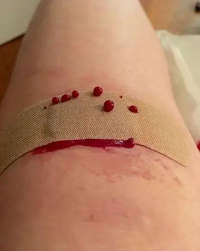 创口贴是不能用于急救止血的