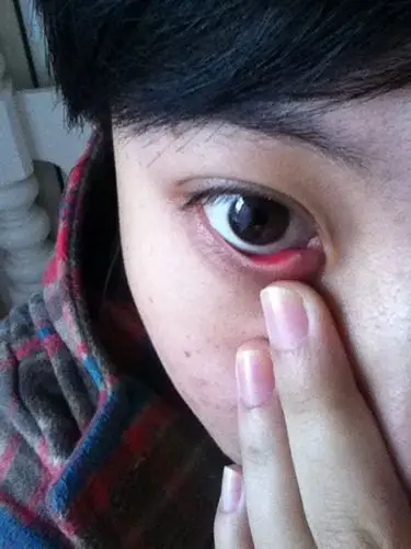 我的眼睛里面肿了一个小包.现在不知道是针眼还是角膜炎