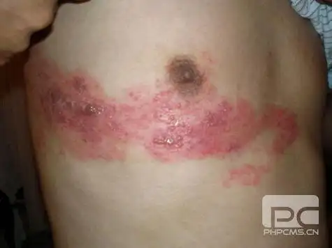 带状疱疹"蛇串疮"的认识与预防 - 好大夫在线