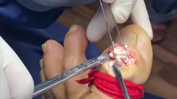 微创切除硬痛风石手术过程,强迫症表示点名要看,超治愈20209030-健康