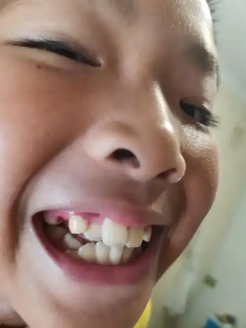 2022年5月17日晚,上排右四第一双尖牙终于掉了,疼了好几天,一直掉不