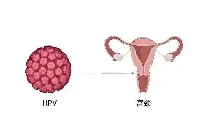 健康科普 | hpv 感染了,就一定会得宫颈癌吗?