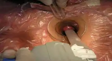 2,痔疮我们在上海率先开展吻合器手术,较早开展套扎技术,达到微创,微