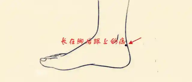 原创五颗最不好的痣相邢克配偶对婚姻和子女不利一生倒霉不断