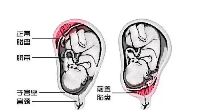 孕妇胎盘前壁好还是后壁好?只要在这个位置都正常,变化了就不行