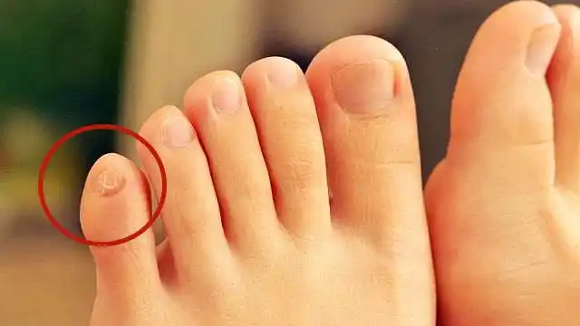 如果你的小脚趾是两瓣的,代表你的祖先可能来自那里