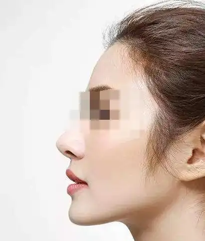 深圳做肋骨综合垫高鼻子效果好的医院有哪些?