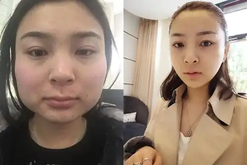 案例展示脸宽国字脸高颧骨怎么整形