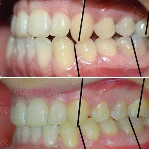 牙齿矫正侧面前后对比