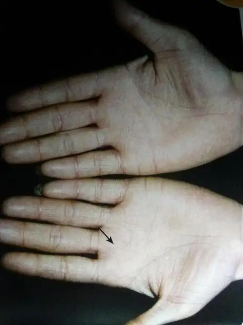 风水玄学  手相掌纹 9线对诊断肿瘤有什么特殊意义科研征实癌症与环境