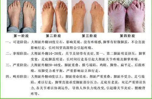 大脚骨外翻怎样治疗1分钟了解大脚骨拇外翻及治疗方法