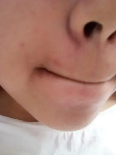 鼻子两侧黑已经半年了