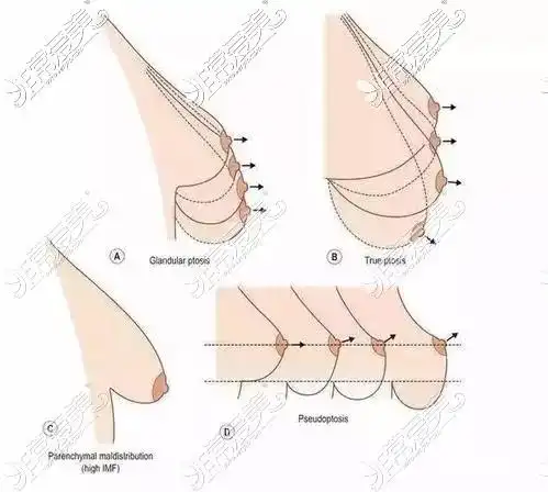 20岁胸下垂像水袋亲身经历告诉你二十岁胸下垂还能恢复吗